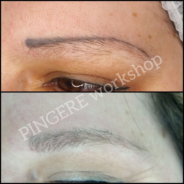 Безпечне лазерне видалення тату, татуажа.