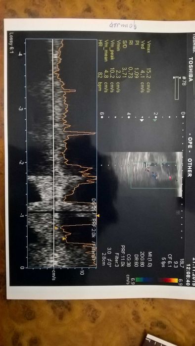 Аппарат УЗИ экспертного класса - Toshiba APLIO MX