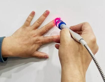 Laser de remoção de fungos das unhas