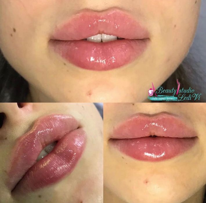 PROMOCJA! Botoks  320 Za 1 strefa