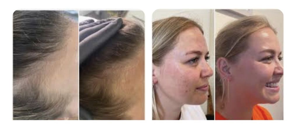 Плазмоліфтінг. Послуги косметолога.