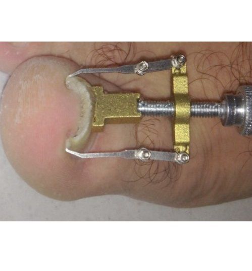 Corretor de unhas encravadas NOVO