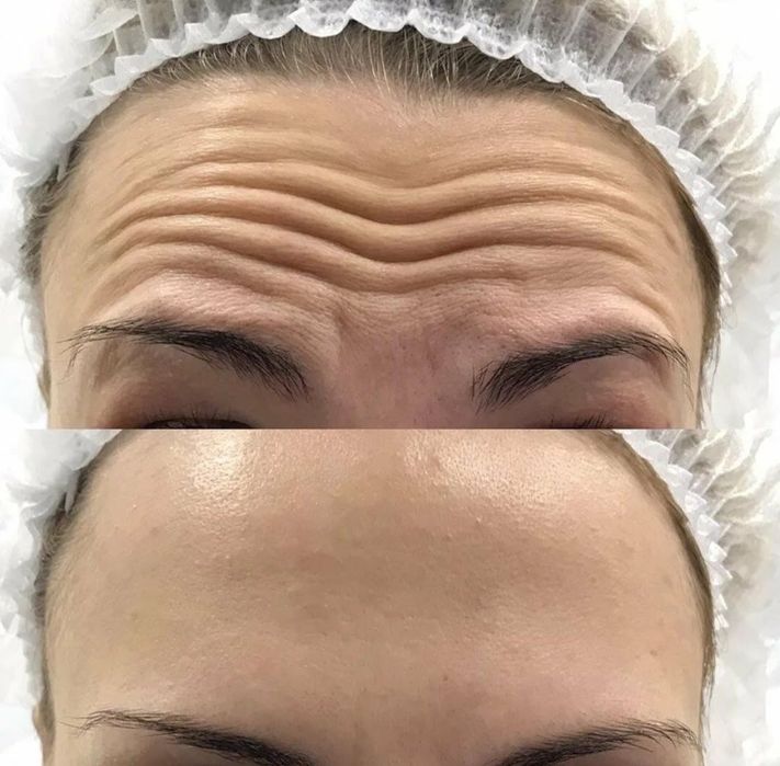 Ботулинотерапия! Гладкое личико! Ботокс!