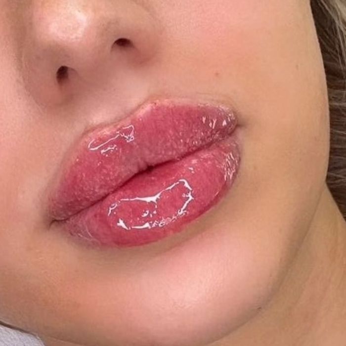 1500 грн губи контурна пластика.Ботокс.