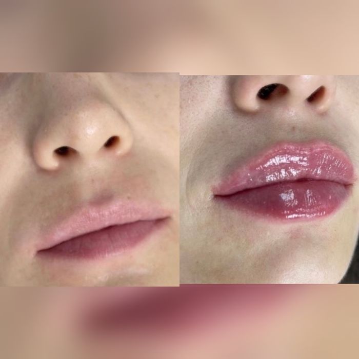 Косметолог.Увеличение губ.Мезотерапия Биоревитализация,Плазмолифтинг,