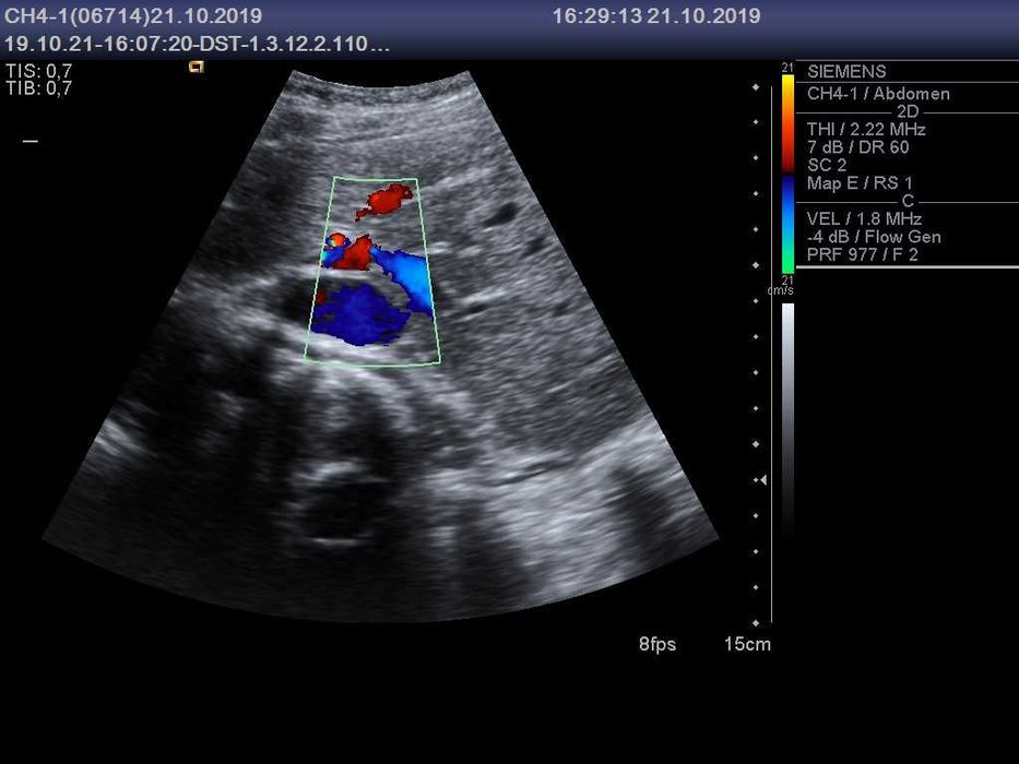 Конвексний датчик УЗД Siemens (Acuson) CH4-1