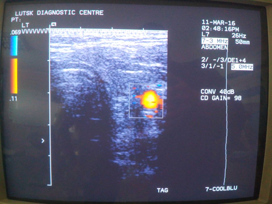 Лінійний датчик УЗД Siemens (Acuson) L7
