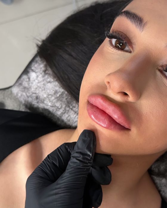 Powiekszanie ust PROMOCJA !!! Botox 200 zl