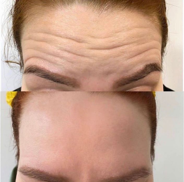 PROMOCJA! Botoks  320 Za 1 strefa