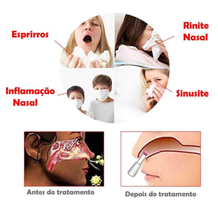 dispositivo de terapia de alergias nasais anti rinite ressonar polipos
