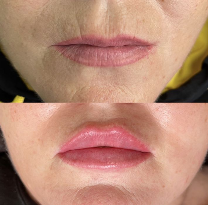 Увеличение губ.Контурная пластика.Ботокс.Биоревитализация.Липолитики.