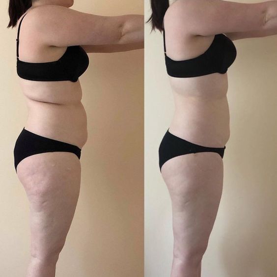 Похудение,ботокс,губы,рф,смасс,косметолог