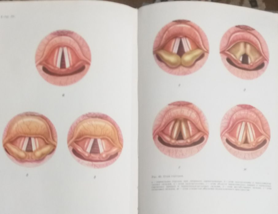 Болезни  уха горла носа
