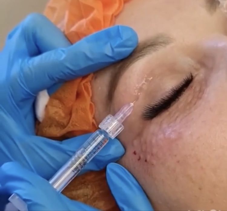 Збільшення губ 1500/3000 | лікар косметолог | моделі