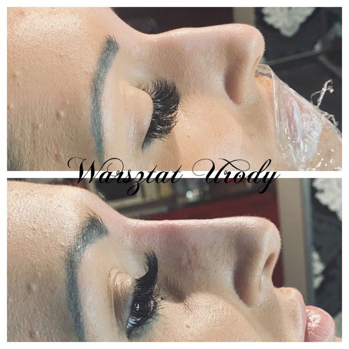 300zł= Kwas Hialuronowy Powiększenie Ust / Wolumetria 250z/ BOTOKS 200