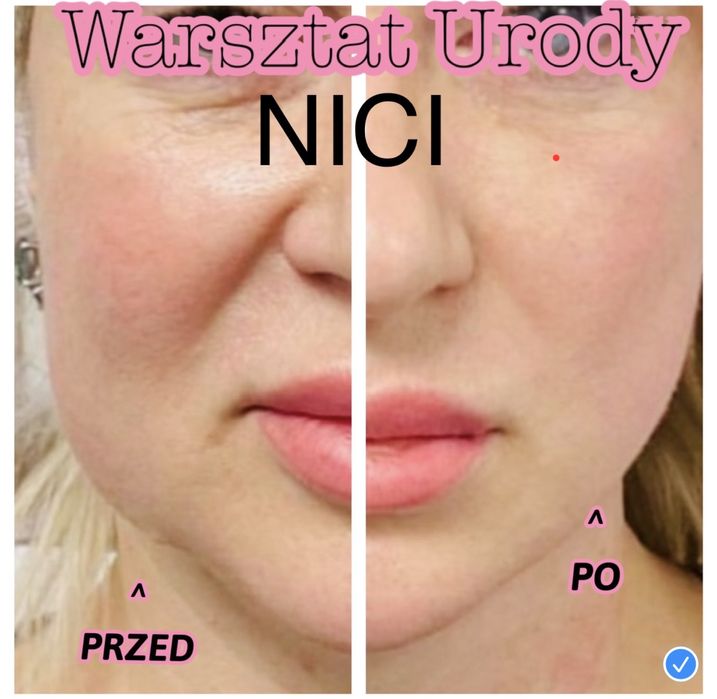 -50% POWIĘKSZANIE UST botox btx kwas hialuronowy NICI HACZYKOWE
