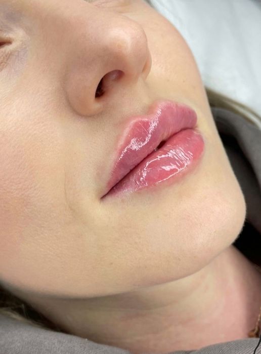 Акція!!Збільшення губ від 2500 грн,Ботокс