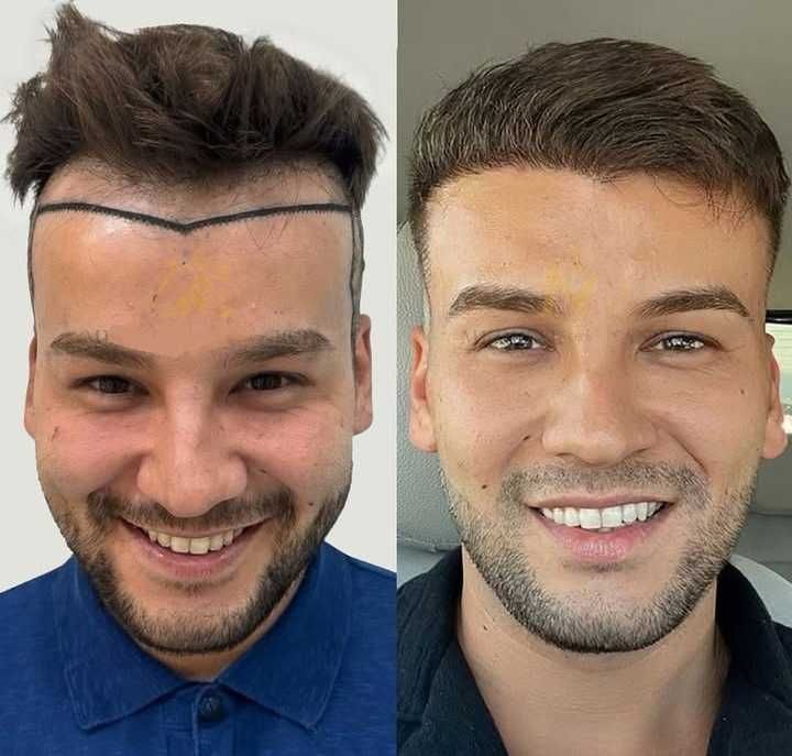 Transplante Capilar/Barba Istambul(Turquia) 2950€ TUDO INCLUIDO