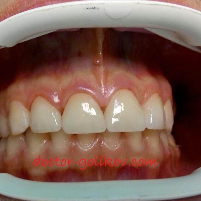 Керамічні вініри. Київ, 13500 грн . Акція! ВСЕ ВКЛЮЧЕНО!!! Е.max