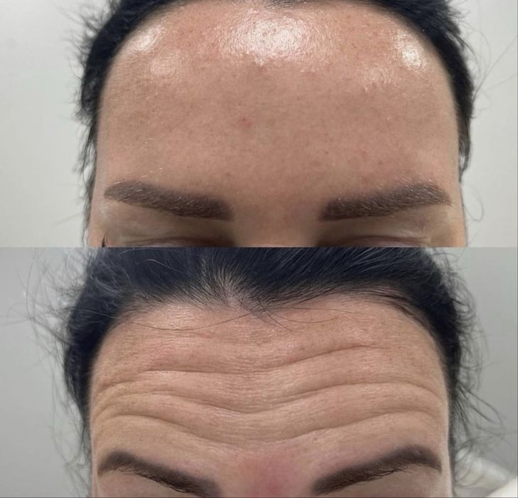 Ботокс! Ботулінотерапія