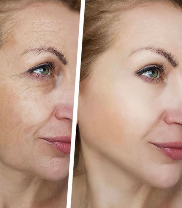 Usta/botox/mezoterapia