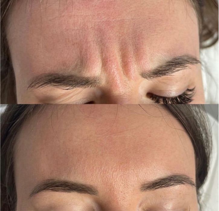 Botoks Azzalure 200 zl okolica