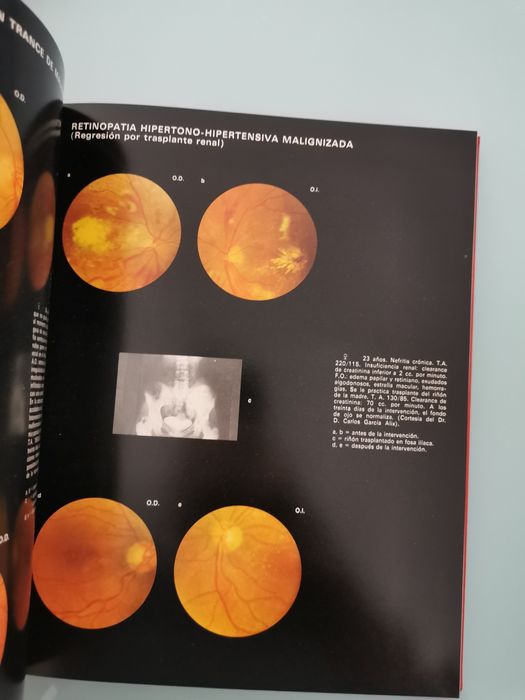 Atlas de Retinopatias vasculares