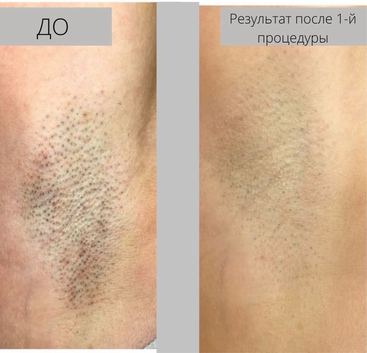 Лазерная эпиляция