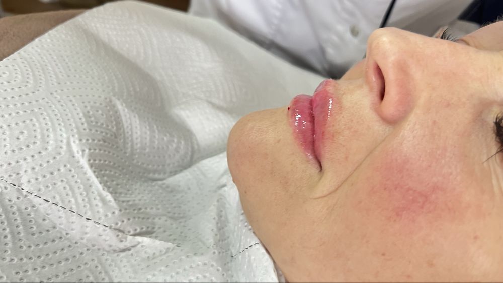 Увеличение губ , ботулинотерапия, контурная пластика