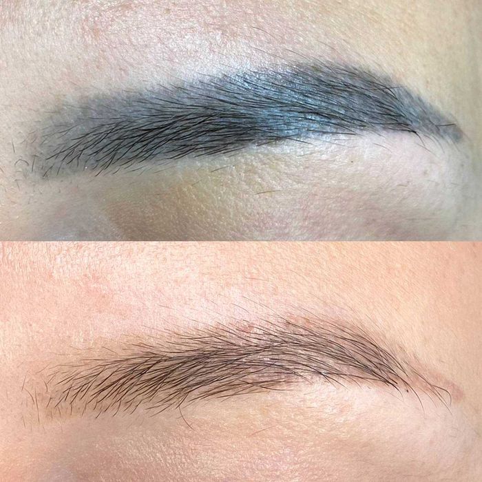 Видалення тату, татуювань і перманенту лазером. Київ, Лівий берег