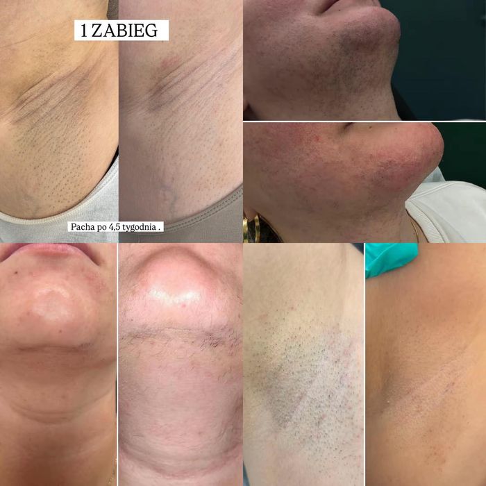 Współpraca – epilacja laserowa