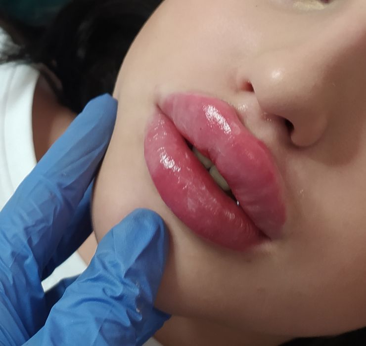 АКЦИЯ!!! Увеличение губ 1700 грн. Колличество мест ограничено!