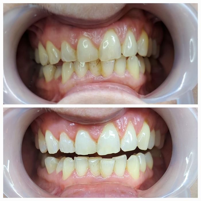 Kosmetyczne wybielanie zębów