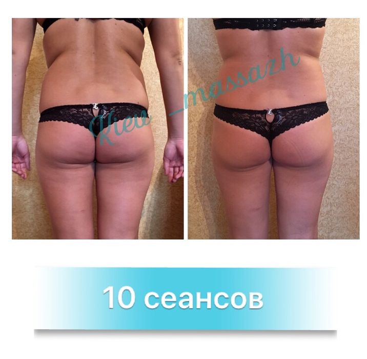 Антицеллюлитный массаж ЖК София