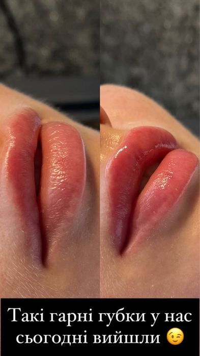 Мікронідлінг губ HYDRA LIPS - Безінʼєкційне зволоження!