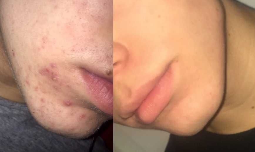 Третиноїн гель для проблемної шкіри A-ret gel 0,05%, 20г., Індія