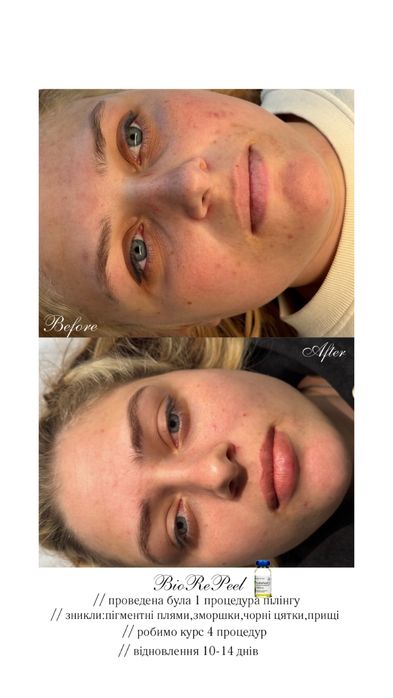 Ботокс чоло-1900 грн!Біоревіталізація, збільшення губ Одеса, центр