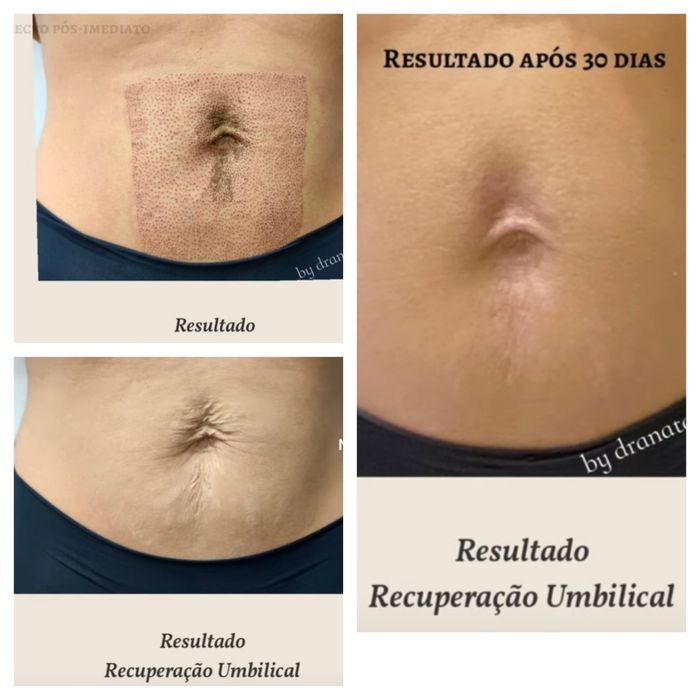 remoção de verrugas e rejuvenecimiento!