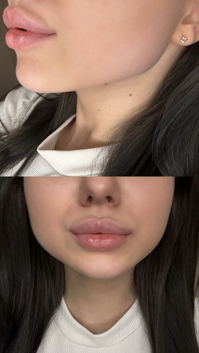 Лікар косметолог іньʼєкционіст АКЦИЯ ! Губы 1800/2000/3500/4400