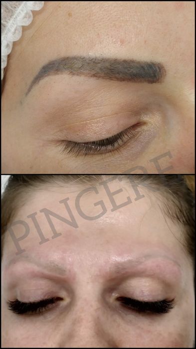 Безпечне лазерне видалення тату, татуажа.