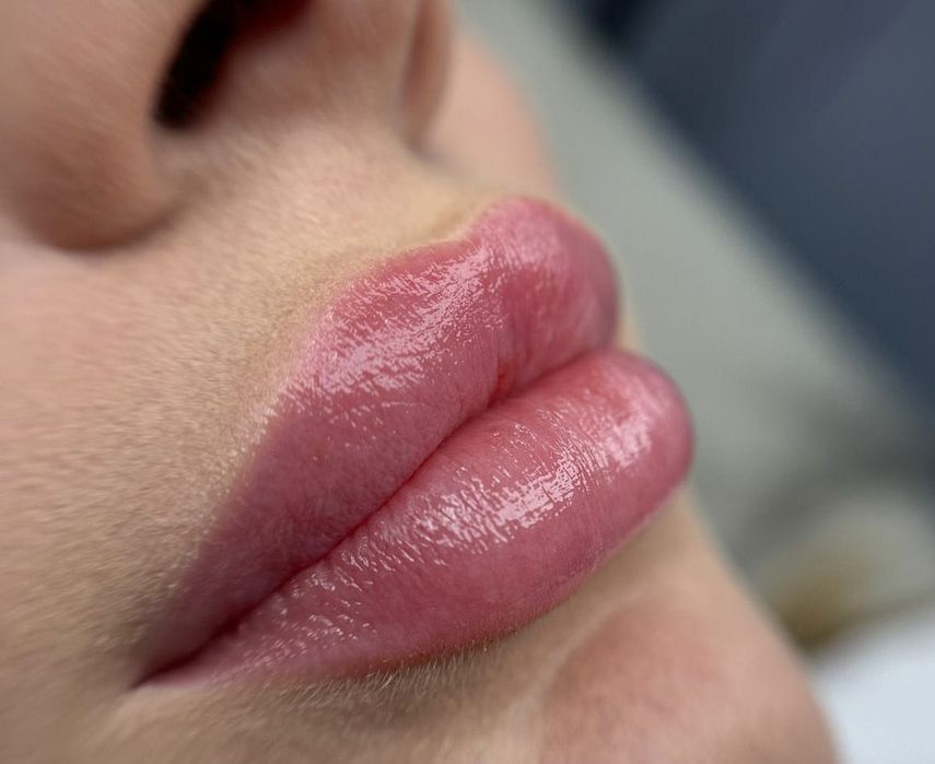 Збільшення губ ,Ботокс,Full Face,ліполітики