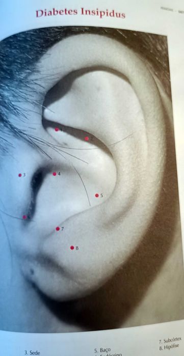 Acupuntura Laser