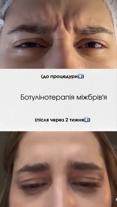 Контурна пластика губ, Біоревіталізація Акція!!!