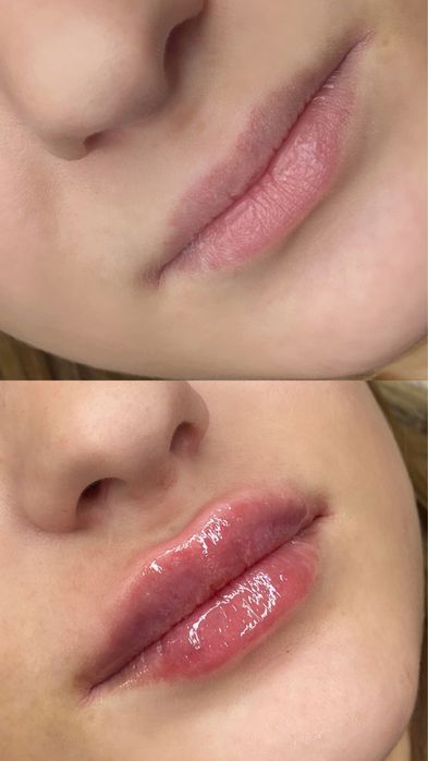 Косметолог-інʼєкціоніст Full Face | Чистка обличчя  Гідропілінг RF