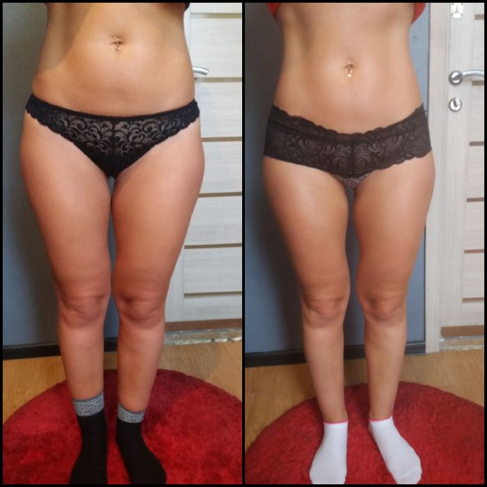 Вакумний антицелюлітний масаж