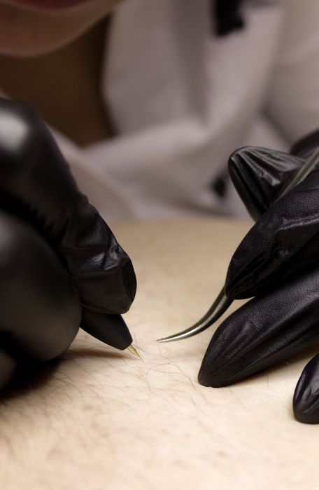 Электроэпиляция Харьков