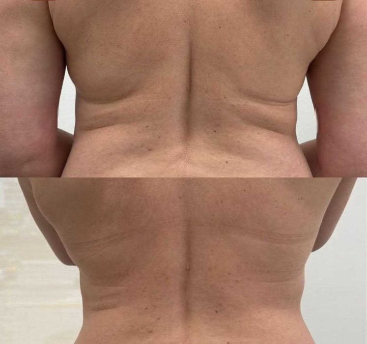 Антицелюлітний вакуумний масаж  • Апаратні методики • Масаж обличчя