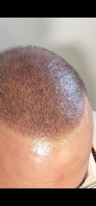 Micropigmentação Capilar fio a fio