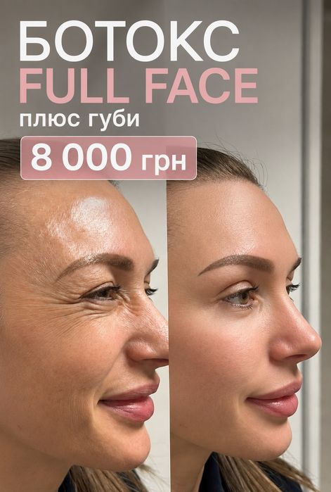 збільшення губ косметолог, біоревіталізація, збільшення скул, фул фэйс  ушки Прокол.