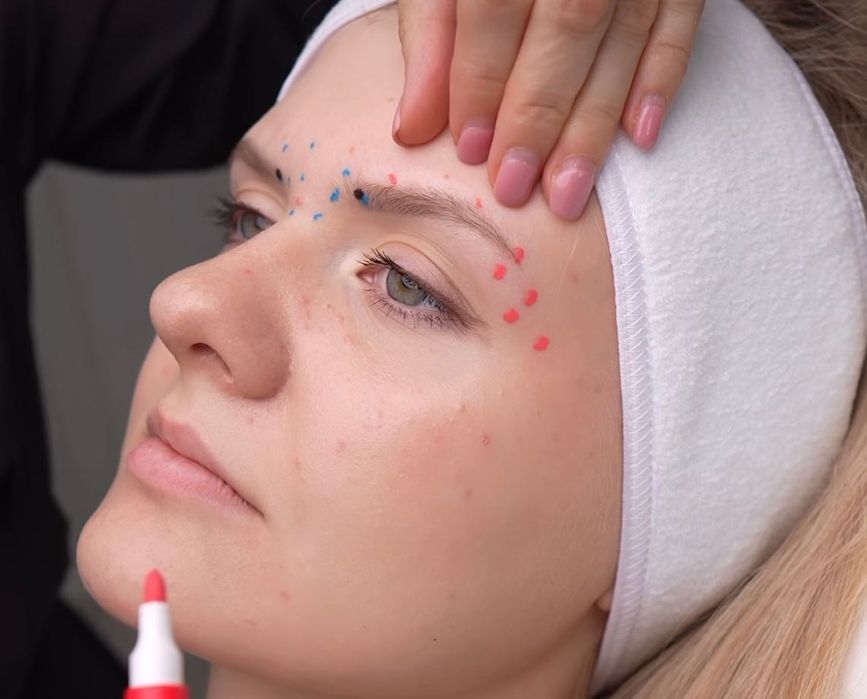 Збільшення губ ,Ботокс,Full Face,ліполітики